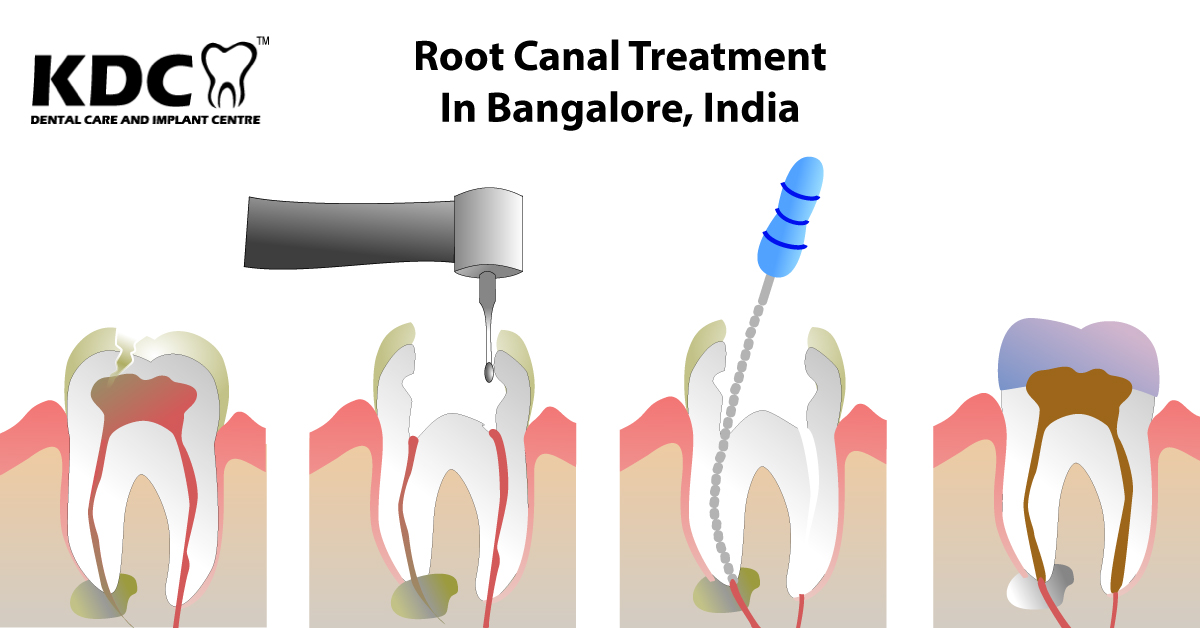 Dental Root Canal Treatment in RR Nagar, Dental Root Canal Treatment in JP.Nagar, Dental Root Canal Treatment in Vidyaranyapura, Dental Root Canal Treatment in Konanakunte, Dental Root Canal Treatment in Sunkadakatte, Dental Root Canal Treatment in Hubli